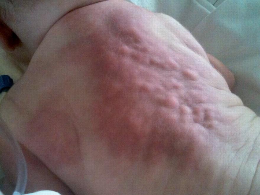 Therapeutic Hypothermia skin Therapeutic Hypothermia skin